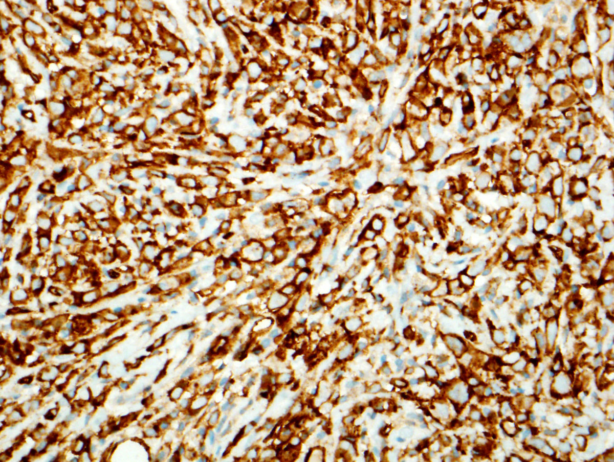 Fig. 6 The blasts were positive for CD31.